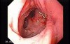 Colonic Interposition for Esophageal Substitution (10 of 11)