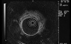 Long Standing Alcohol Abuse - Radial Endosonography, Part 1