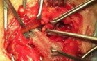UHS- hernia repair