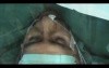 Awake Aortic Valve Replacement (AVR) - Thoracic Epidural Anaesthesia