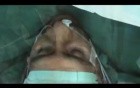 Awake Aortic Valve Replacement (AVR) - Thoracic Epidural Anaesthesia