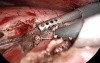 Cystogastrostomy - pancreatic pseudocyst