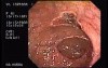 Tubulo - Villous Adenoma - Endoscopy (27 of 28)
