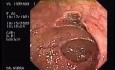 Tubulo - Villous Adenoma - Endoscopy (27 of 28)