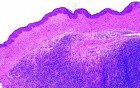 Tasmanian Devil Facial tumor (DFTD)
