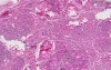 Nodular goiter