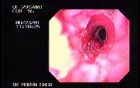 Reflux Esophagitis & Esophageal Stricture - Hiatal Hernia