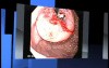 Gastrointestinal endoscopies of different stomach cancer