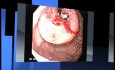 Gastrointestinal endoscopies of different stomach cancer