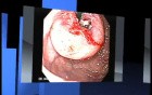 Gastrointestinal endoscopies of different stomach cancer