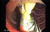 Dental Prothesis Found in the Jejuno (2 of 9)