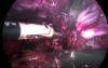 Treatment for Severe Endometriosis - Total Hysterectomy by Laparoscopic Method