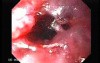Perforation of a Esophageal Carcinoma after the procedure with hydrostatic balloon dilation (3 of 12)