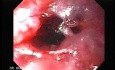 Perforation of a Esophageal Carcinoma after the procedure with hydrostatic balloon dilation (3 of 12)