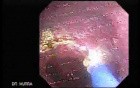 Barrett's Esophagus of long segment (21 of 24)