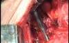 Perforation of a Esophageal Carcinoma after the procedure with hydrostatic balloon dilation (7 of 12)