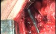 Perforation of a Esophageal Carcinoma after the procedure with hydrostatic balloon dilation (7 of 12)