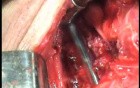 Perforation of a Esophageal Carcinoma after the procedure with hydrostatic balloon dilation (7 of 12)