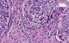 Bladder - Urothelial Carcinoma Grade I