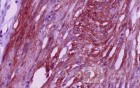 Jejunal Gastrointestinal Stromal tumor (GIST) (14 of 86)
