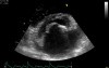 Stenosis of Mitral Valve caused by Rheumatic Heart Disease
