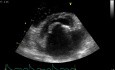 Stenosis of Mitral Valve caused by Rheumatic Heart Disease