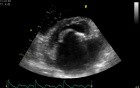 Stenosis of Mitral Valve caused by Rheumatic Heart Disease