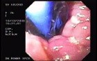 Esophageal Achalasia (14 of 16)