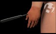 Treatment of Necrotizing Fasciitis