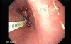 Adenocarcinoma of the Middle Third of Esophagus - Biopsy of the Lesion