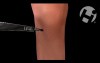 Knee Menisectomy