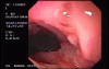 Crohn's Disease - Endoscopy (13 of 28)