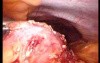 Gastrointestinal Stromal Tumor - GIST (37 of 65)