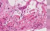 Metastatic breast carcinoma - Histopathology - Heart, pericardium
