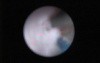 Laser Ureteroscopy - Part 1