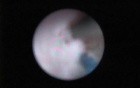Laser Ureteroscopy - Part 1