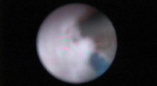 Laser Ureteroscopy - Part 1