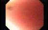 Achalasia - Residual Food - 50 Year-Old Lady