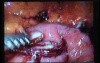 Jejunal Gastrointestinal Stromal tumor (GIST) (41 of 86)