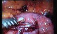 Jejunal Gastrointestinal Stromal tumor (GIST) (41 of 86)