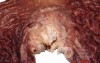 Adenocarcinoma of the cardias and gastric fundus with signet-ring cells (14 of 25)