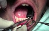 Graft Suturing Technique - Gingival Grafting #26-25-24