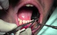 Graft Suturing Technique - Gingival Grafting #26-25-24