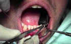 Graft Suturing Technique - Gingival Grafting #26-25-24