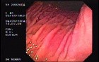 Multiple Gastric Polyps - Body and Fundus