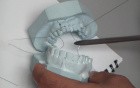 Jaw Fracture - Embrasure Wires