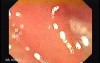 Colonic Tuberculosis Mimicking Crohn's Disease (2 of 12)