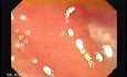 Colonic Tuberculosis Mimicking Crohn's Disease (2 of 12)