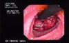 Familial Adenomatous Polyposis of the Colon (8 of 29)