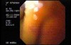 Yellowish endoscopical larynx view during ictericia